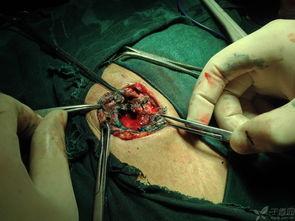 取出皮埋手术视频,专业视频带你直观了解