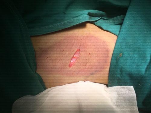 腋臭手术视频过程,专业解析与真实案例分享