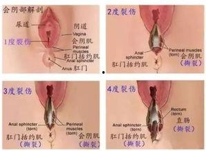 产科侧切缝合术视频,产科侧切缝合术操作步骤详解